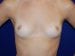 Breast Augmentation 10 Patient Before - 2 Thumbnail