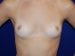Breast Augmentation 10 Patient Before - 2 Thumbnail