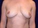 Breast Augmentation 03 Patient Before Thumbnail