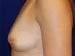 Breast Augmentation 05 Patient Before - 2 Thumbnail