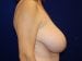 Breast Reduction Patient Before - 2 Thumbnail
