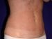 Liposuction 01 Patient After - 2 Thumbnail