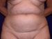 Tummy Tuck 01 Patient Before Thumbnail