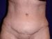 Tummy Tuck 01 Patient After Thumbnail