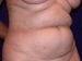 Tummy Tuck 01 Patient Before - 2 Thumbnail