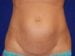 Tummy Tuck 02 Patient Before Thumbnail