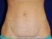 Tummy Tuck 02 Patient After Thumbnail