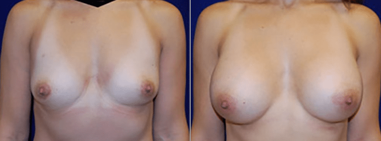 Breast Augmentation Before and After Photo with Natural Looking Results