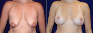 before-and-after-breast-lift-surgery