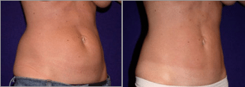 Before and After Liposuction Surgery