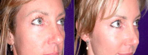 Rhinoplasty Before and After Photos