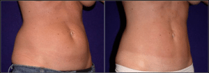 Before and After Liposuction Patient by Dr. Morales