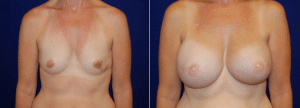 Bilateral Latissimus Flap Reconstruction with Silicone Implants by Dr. Morales