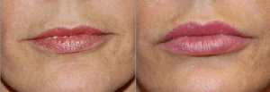 Morales LIP AUGMENTATION