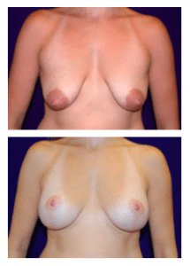 Breast Lift Patient by Dr Morales