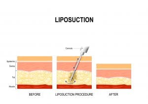 liposuction procedure Before and after fat modeling and surgery