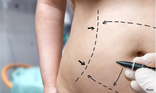 A woman undergoing a consultation for a tummy tuck.