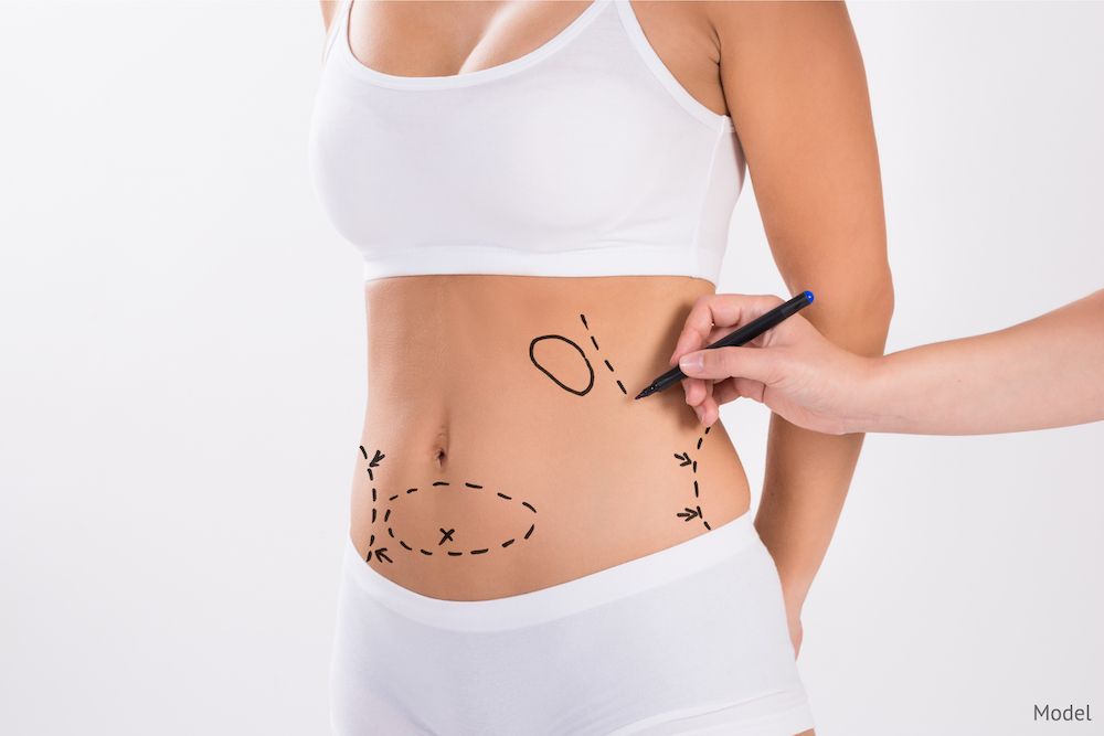 A woman going through a liposuction consultation.