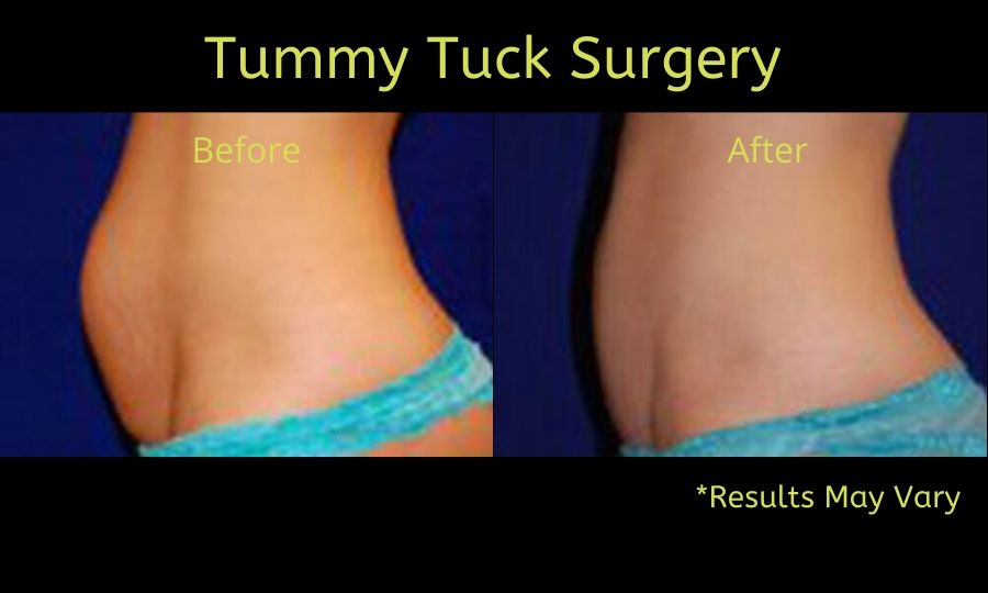 Before and after a tummy tuck surgery.