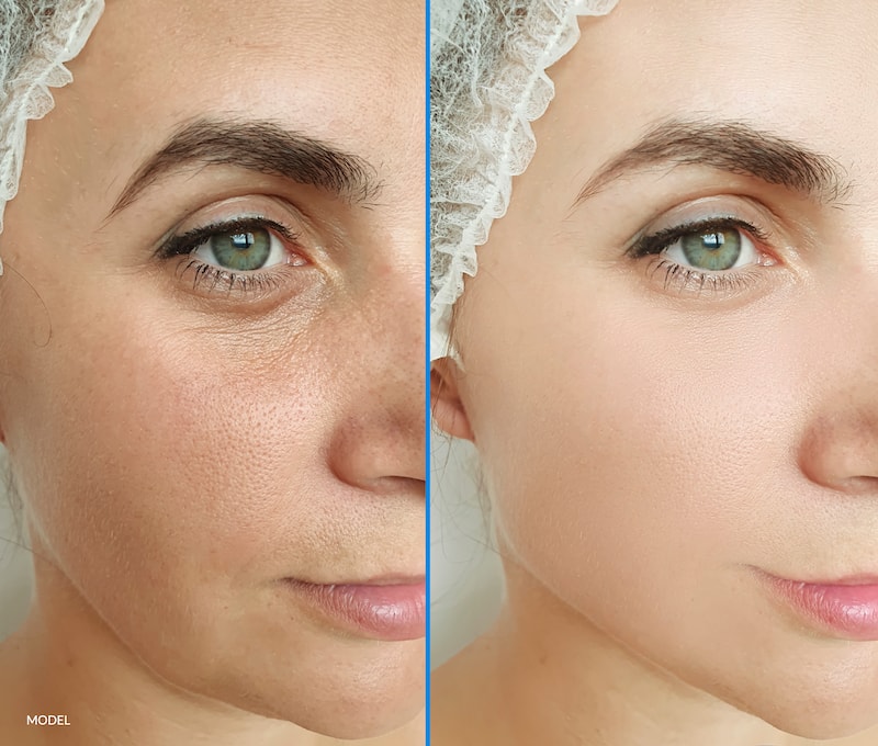 Model image showing the before and after results of a facial rejuvenation treatment.