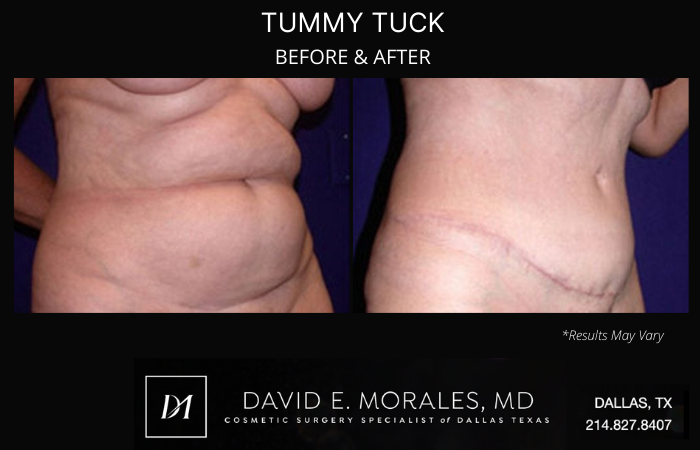 Before and after image showing the results of a tummy tuck performed in Dallas, TX.