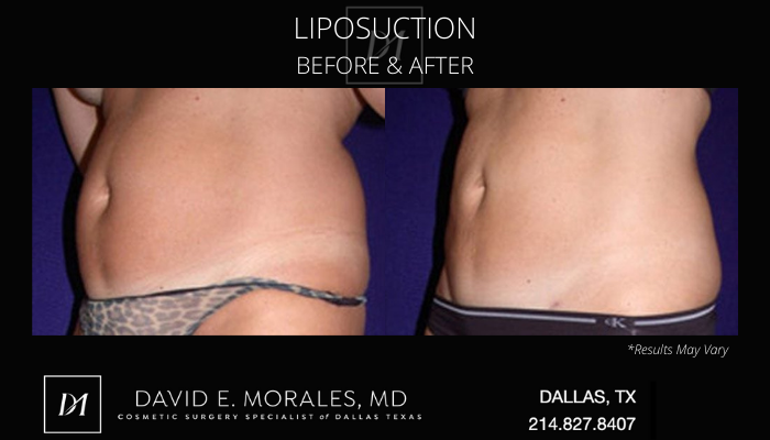Before and after image showing the results of a liposuction treatment performed in Dallas, TX.