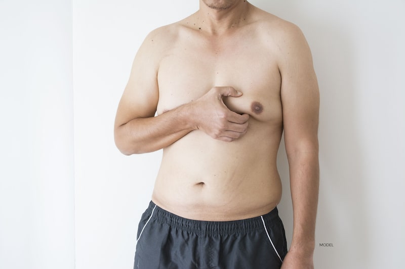 Man with gynecomastia squeezes his enlarged breast.