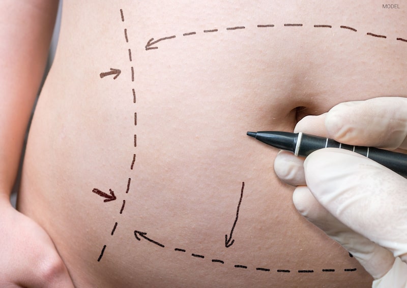 Close-up of a patient's abdomen with surgical markings for a tummy tuck