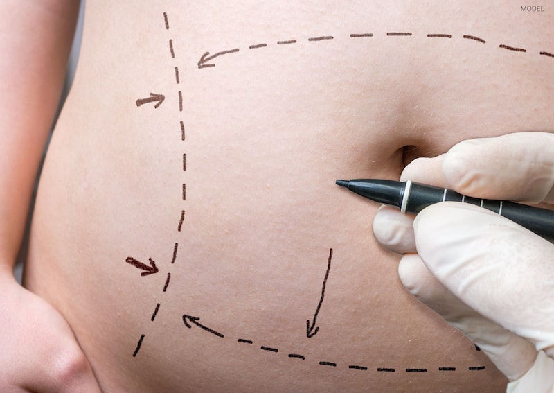 10 Things to Know About Tummy Tuck Surgery