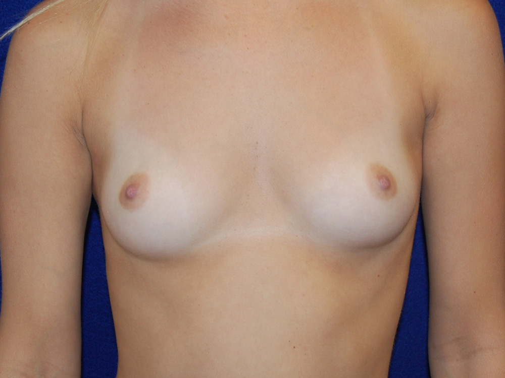 Case--1665 | Before Breast Augmentation