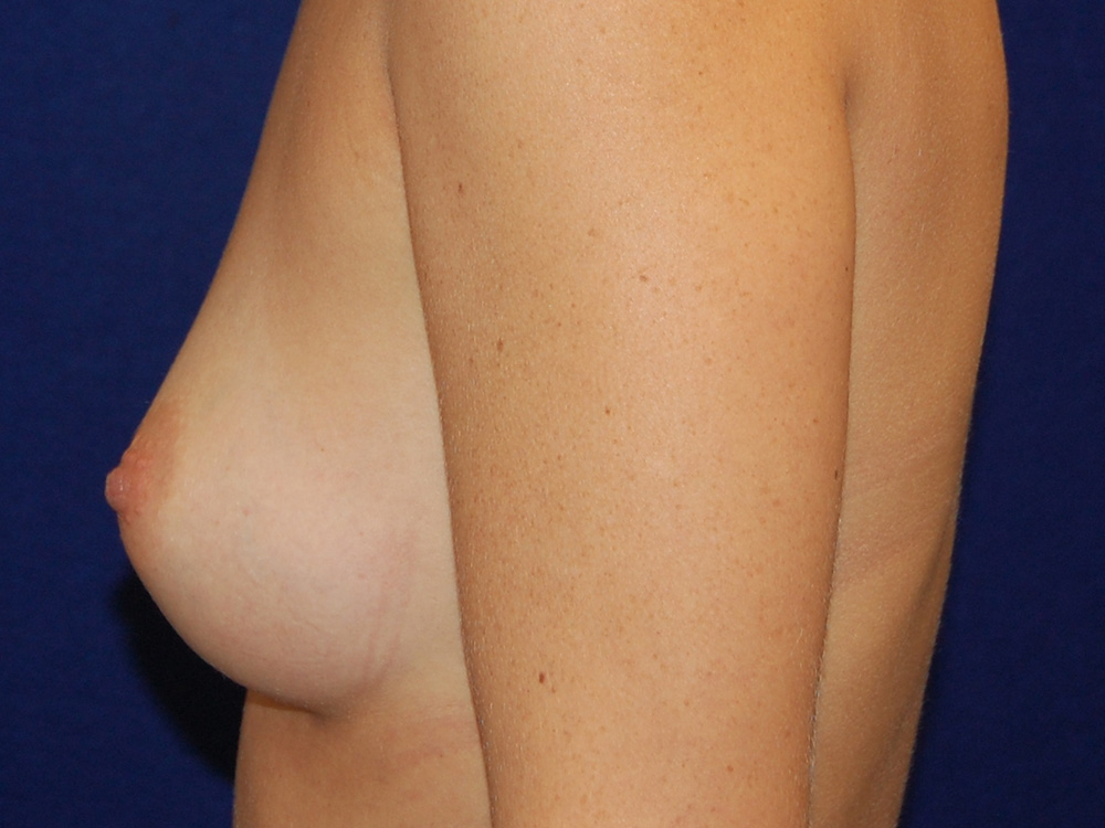 before breast augmentation with silicon implants Case #6108 - side view