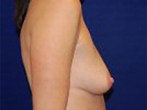 before breast augmentation Case #4977 - side view