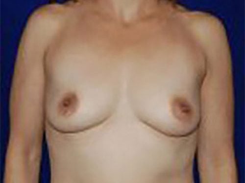 Case--5363 | Before Breast Augmentation