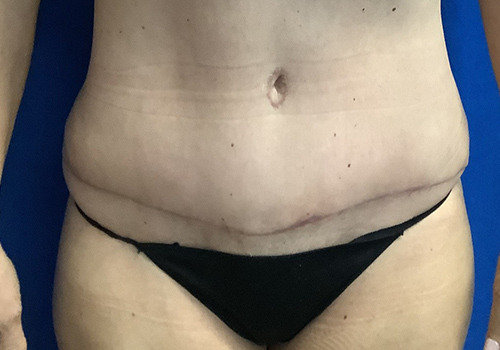 Case--3418 | After Tummy Tuck