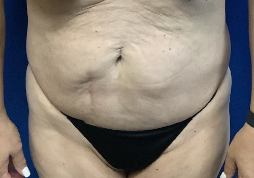 Case--3418 | Before Tummy Tuck