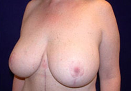 after breast lift surgery Case #5179 - side view