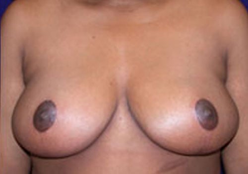 Case--7229 | After Breast Reduction