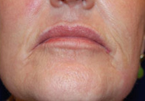 Case--7924 | After Lip Augmentation