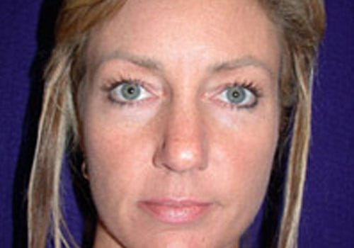 Case--9187 | Before Rhinoplasty