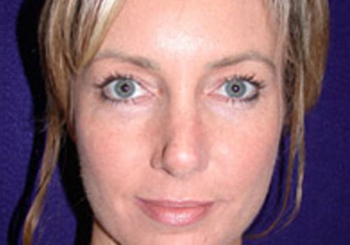 Case--9187 | After Rhinoplasty