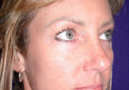 before rhinoplasty surgery Case #9187 - side view