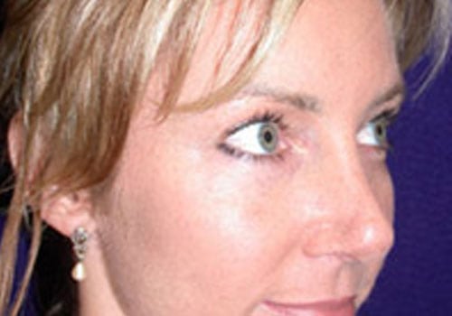 after rhinoplasty surgery Case #9187 - side view