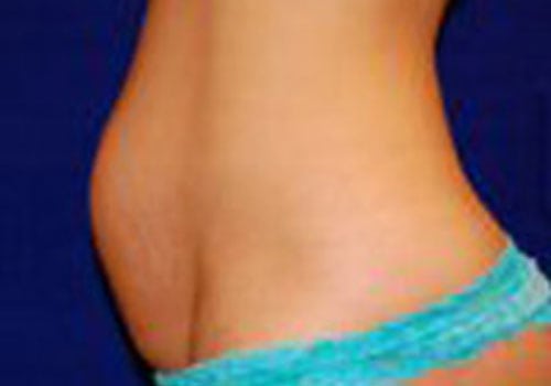 before tummy tuck surgery Case #6036 - side view
