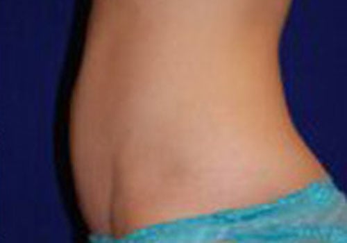 after tummy tuck surgery Case #6036 - side view